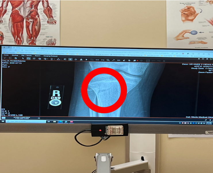 X-Ray of the cracked bone in my knee is circled in red. 